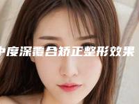 中度深覆合矫正整形效果如何