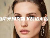 拉萨牙周炎龈下刮治术后遗症有哪些