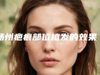 扬州疤痕部位植发的效果很明显吗